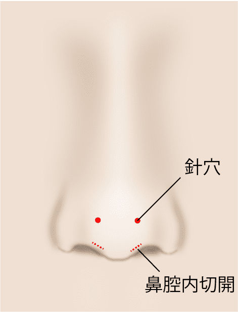 ①鼻の穴に小さな切開を加える